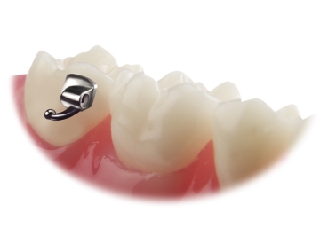 VIPER™, Lepicí bukální trubička Mini (zub 17, 37) standard .018" (zkroucení 0°, offset 0°)