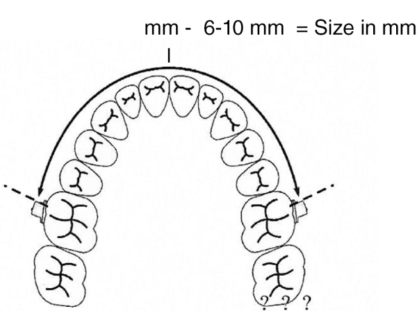 Molární distalizační oblouk, velikost 6 (95 mm)