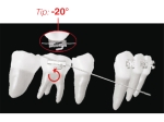 XBT Lepicí bukální trubička k napřímení / ukotvení, zub 46, 36