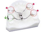Multifunctional orthodontic screw, 4 arms, right